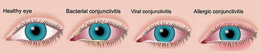 conjunctivitis treatment hamilton northcare pharmacy